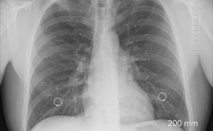 Lung Transplant Coronavirus Lung Transplant Coronavirus