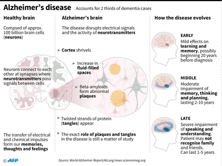La maladie d'Alzheimer La maladie d'Alzheimer