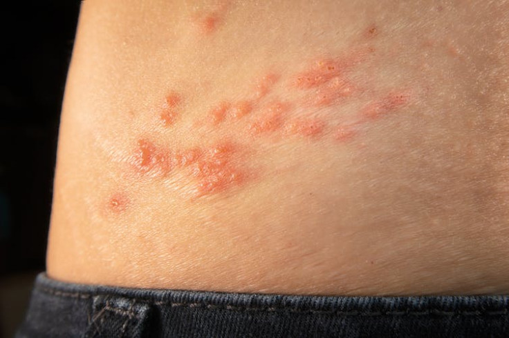  People with shingles develop a painful rash, often on the torso.