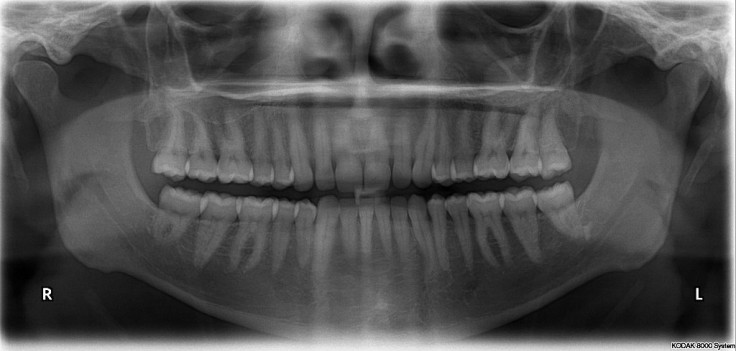Dental x ray