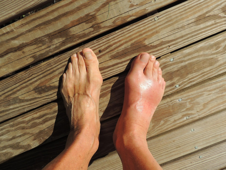 Symptoms of chronic venous insufficiency