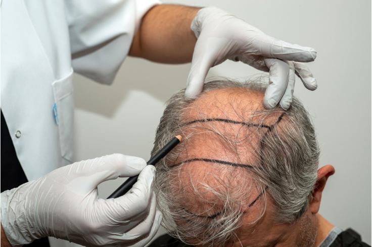 hair transplant