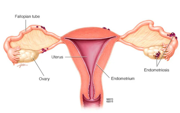 Endometriosis on women