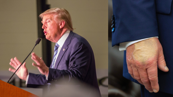 Donald Trump Swollen Hand Update