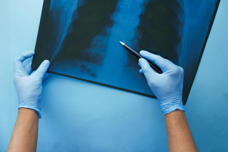X-ray of lungs