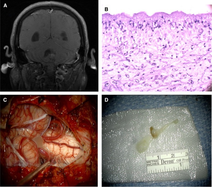 Intraoperative Finding of Neurocysticercosis