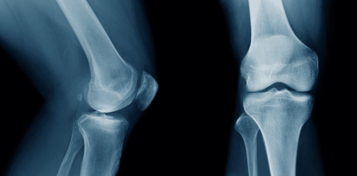 Knee Xray