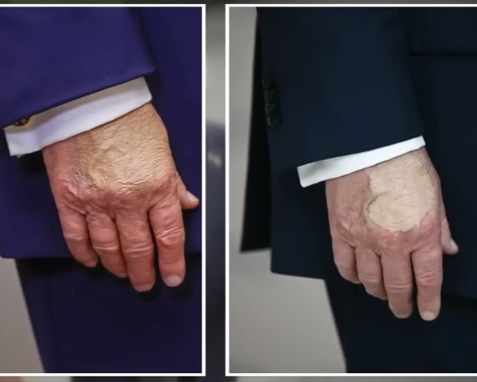 President Donald Trump Applies Makeup To Conceal Bruise As Health Queries Grow