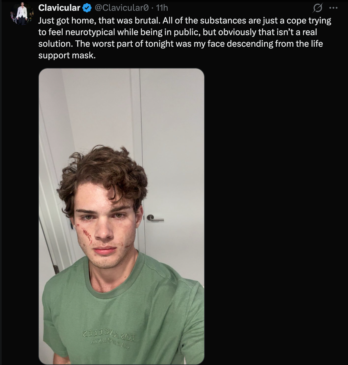Clavicular Revelation: Looksmaxxing Influencer Claims 'Face Descending' from Life Support Mask Was Worse Than Overdose