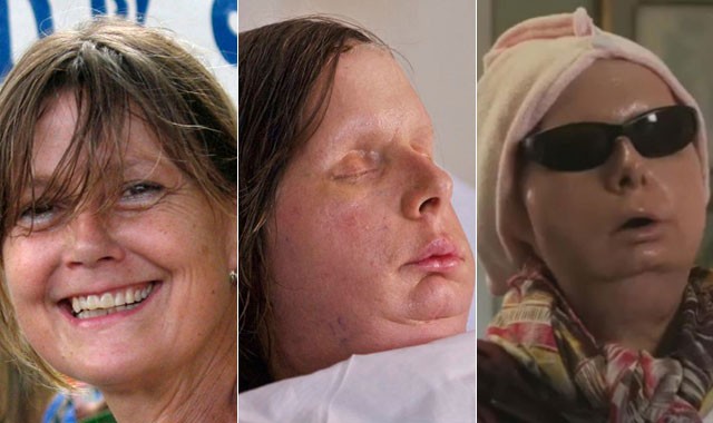 Woman Attacked By a Chimp Has Face Transplant (VIDEO) + (PICTURES)