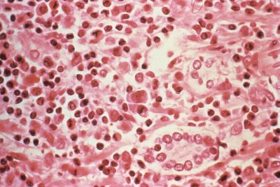Hantavirus