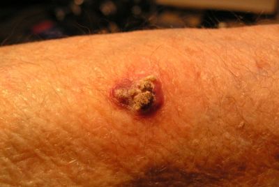Squamous Cell Carcinoma