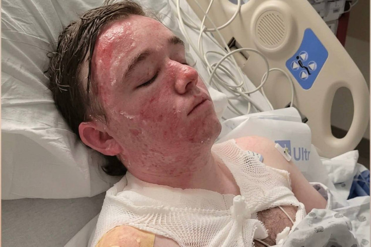 Jacob Smith Recovering in UC Davis Hospital After McDonald’s Hot