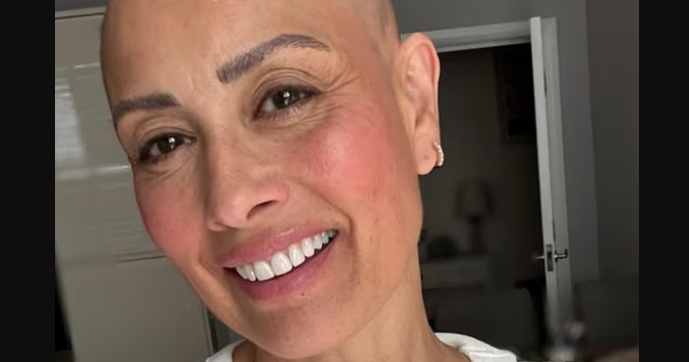 'Two-Thirds Bald' But 'Vibrating High': How Melanie Sykes Turned PTSD‐Linked Alopecia Into a Post‐Traumatic Growth Story