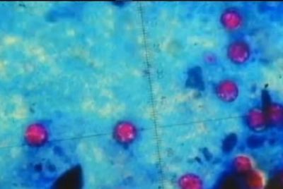 Cyclosporiasis