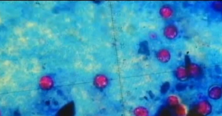 Cyclosporiasis