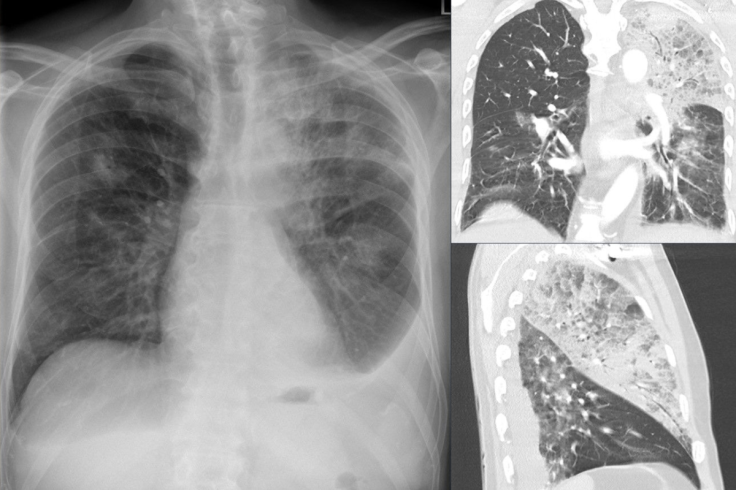 In humans, Legionella infection is called Legionnaires’ disease.