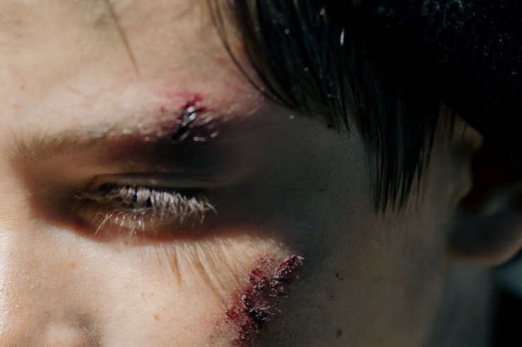 polish man broken nose