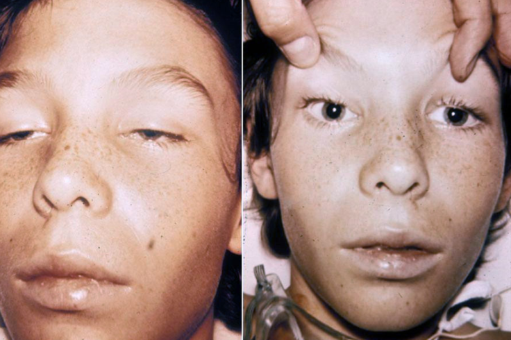 Boy Showing Symptoms Consistent With Botulism