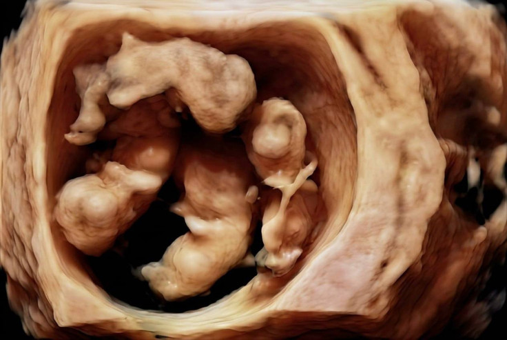 Brisbane Mum’s Identical Quadruplet Pregnancy
