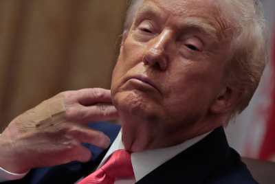 Donald Trump Bruise Health