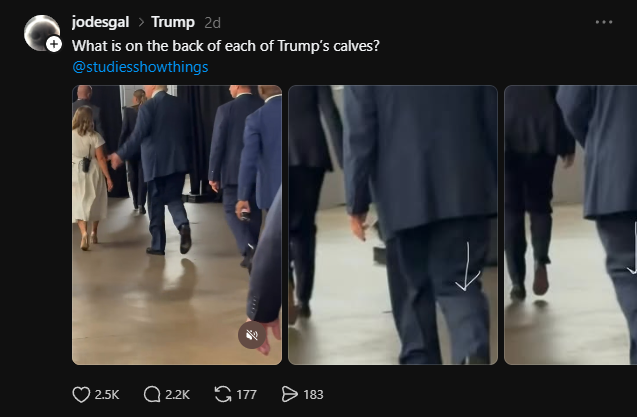 Trump Leg Bulges Explained: What Chronic Venous Insufficiency Is, and Why Photos Cannot Diagnose It