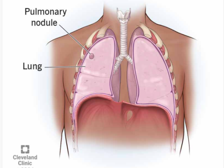 Pope Leo Localized Nodule