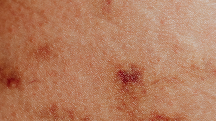 Rashes