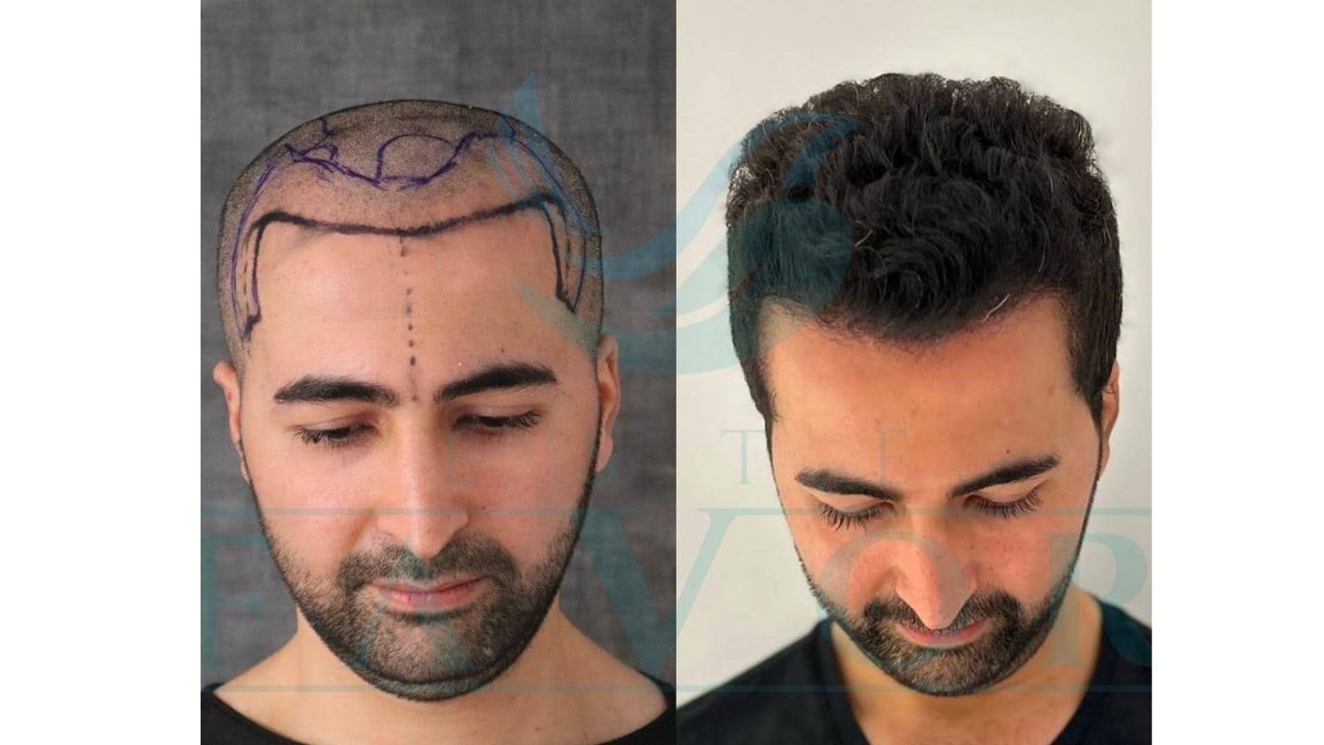 Hair transplant