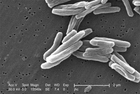 Tuberculosis Reaches Lowest Levels Since 1953 In U.S.