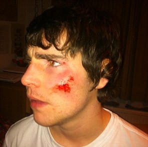 Sam Main’s injuries following the incident that was shown on the YouTube video, ‘Scotrail No Ticket’.