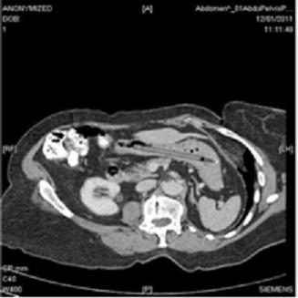 A 76-year-old woman had a ball-point pen removed from her stomach by a surgeon 25 years after swallowing it whole.