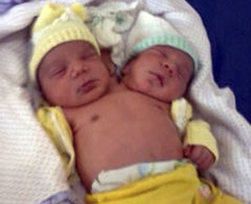 Brazilian Twins Born With Two Heads On Single Body