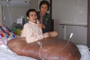 Vietnamese Man Has 200Ib Tumor Removed From Leg [PHOTOS & VIDEO]