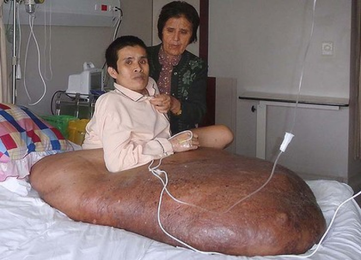 Vietnamese Man Has 200Ib Tumor Removed From Leg [PHOTOS & VIDEO]