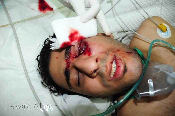 Bahraini protester bleeding from his eye after being injured by riot police, the Barhain Centre for Human Rights says