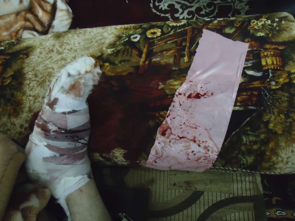 The bandaged foot of a girl, wounded February 5, 2012, is seen as she sits next to her relatives in Baba Amro, a neighbourhood of Homs