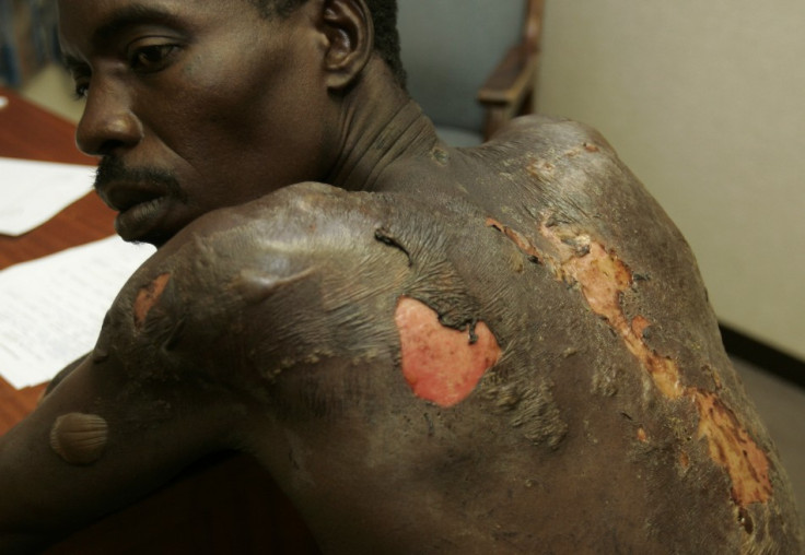 An opposition Movement for Democratic Change (MDC) supporter shows how he was beaten by Zimbabwe army soldiers in the capital Harare