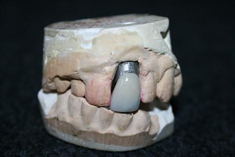 Elvis Presley's dentist kept a spare dental mould in case the singer chipped or cracked his front crown.