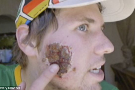 Adam Spencer's face devoured by flesh-eating parasite