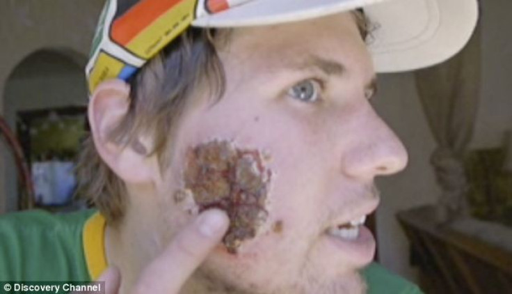 Adam Spencer's face devoured by flesh-eating parasite
