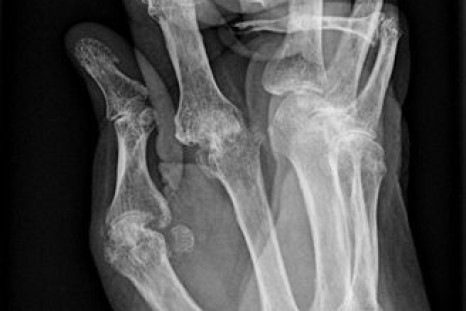 Arthritis Hands X-Ray