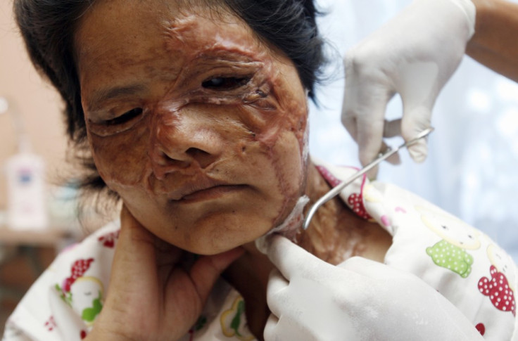 A victim of an acid attack receives treatment at the Cambodia Acid Survivors Charity in Kandal province, west of Phnom Penh