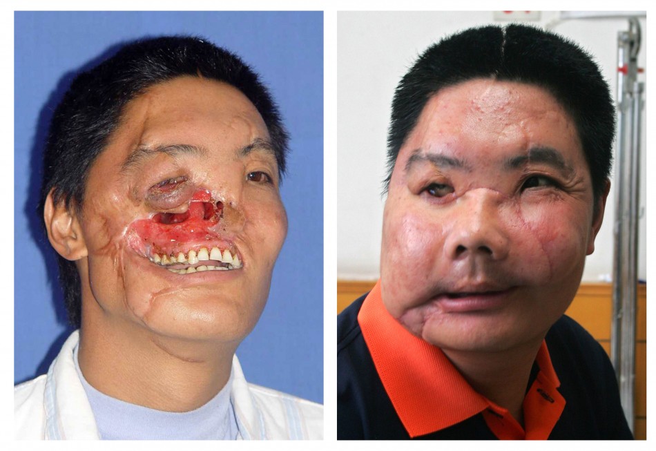 A combination photograph shows a man before and after his operation
