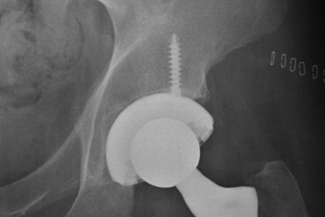 Metal-On-Metal Hip Replacement Patients Are At No Risk Of Developing Cancer