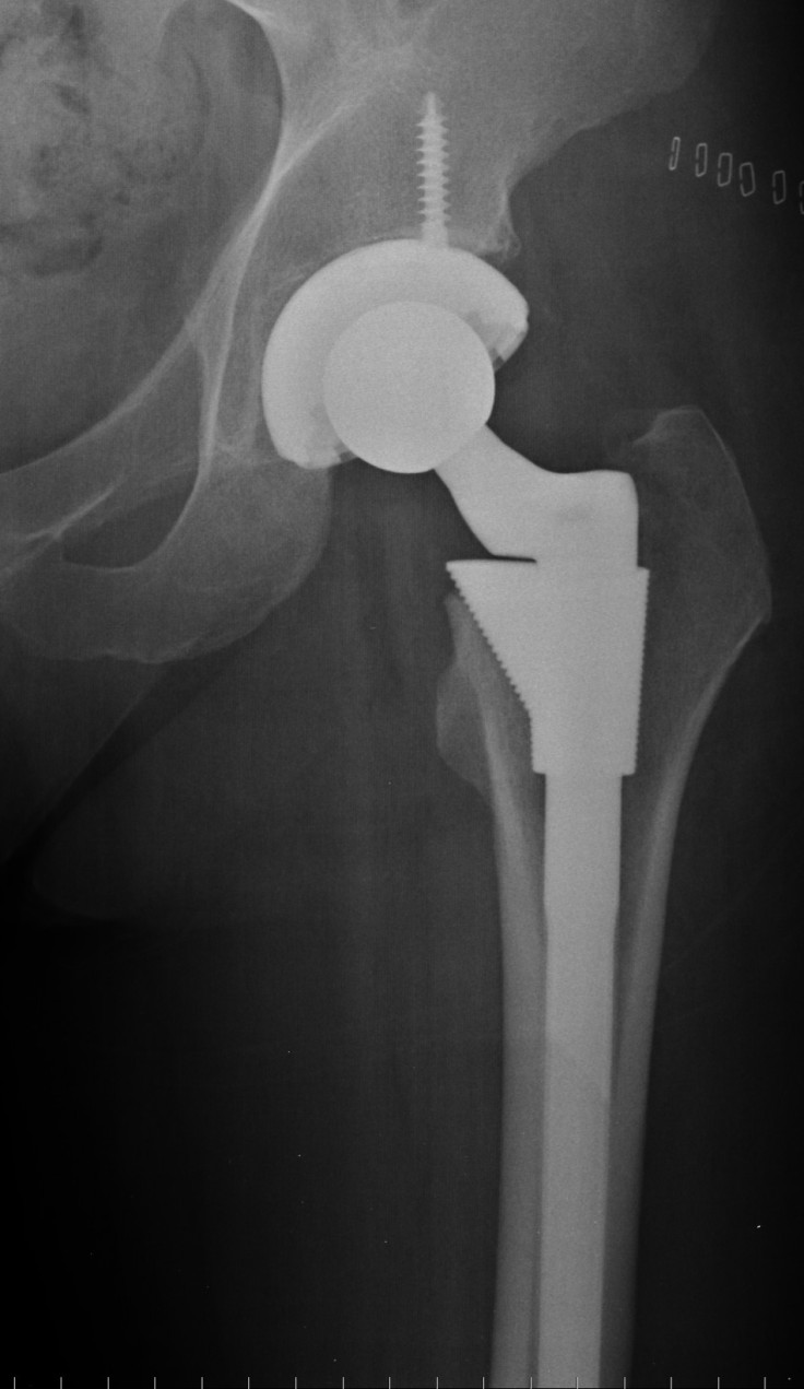 Metal-On-Metal Hip Replacement Patients Are At No Risk Of Developing Cancer