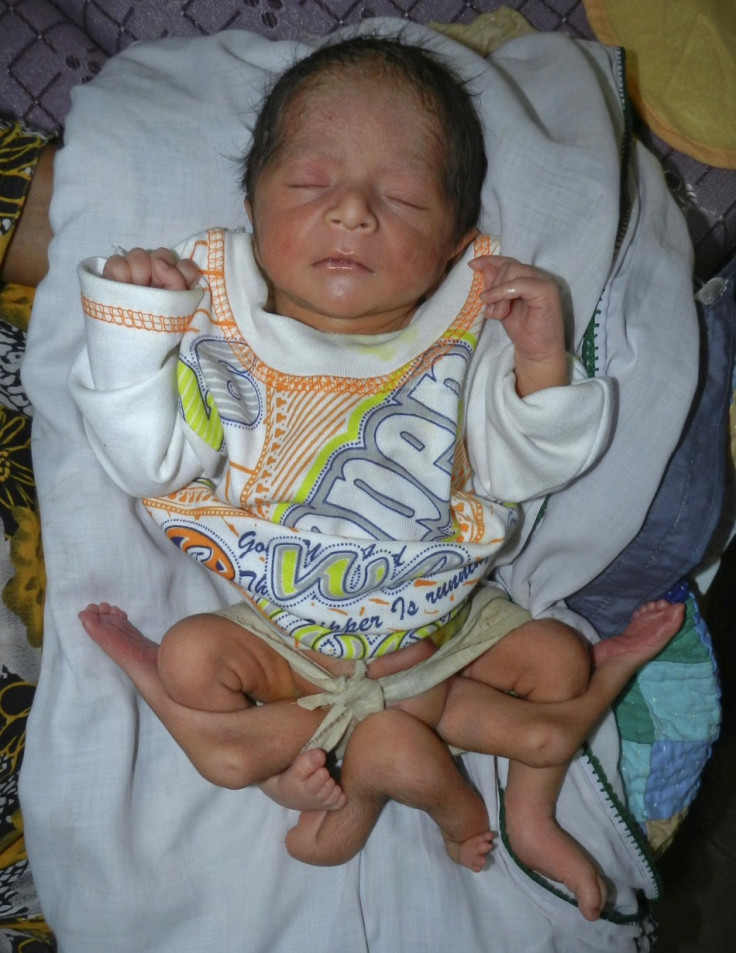 Six-Legged Baby Born Born in Pakistan