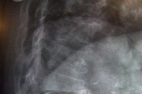 NASA Researchers Develop New Technique to Detect Early Osteoporosis