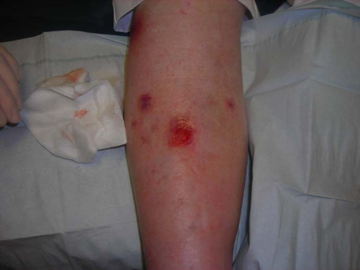 Venous Leg Ulcer