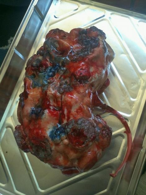 Polycistic kidney cupcake